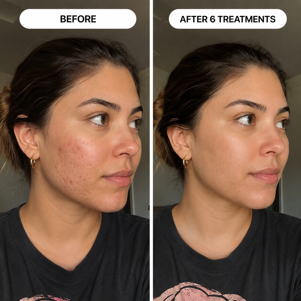 PDRN Micro-Infusion Skin Booster