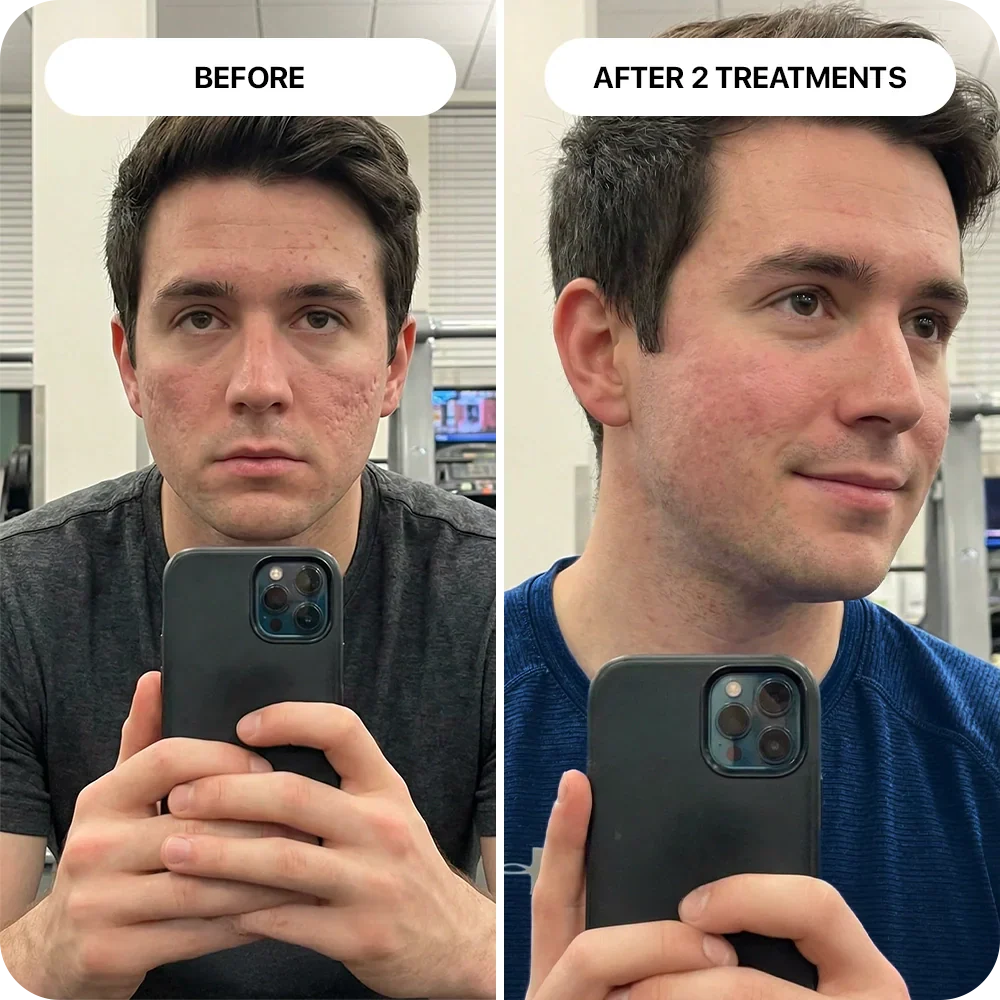 PDRN Micro-Infusion Skin Booster