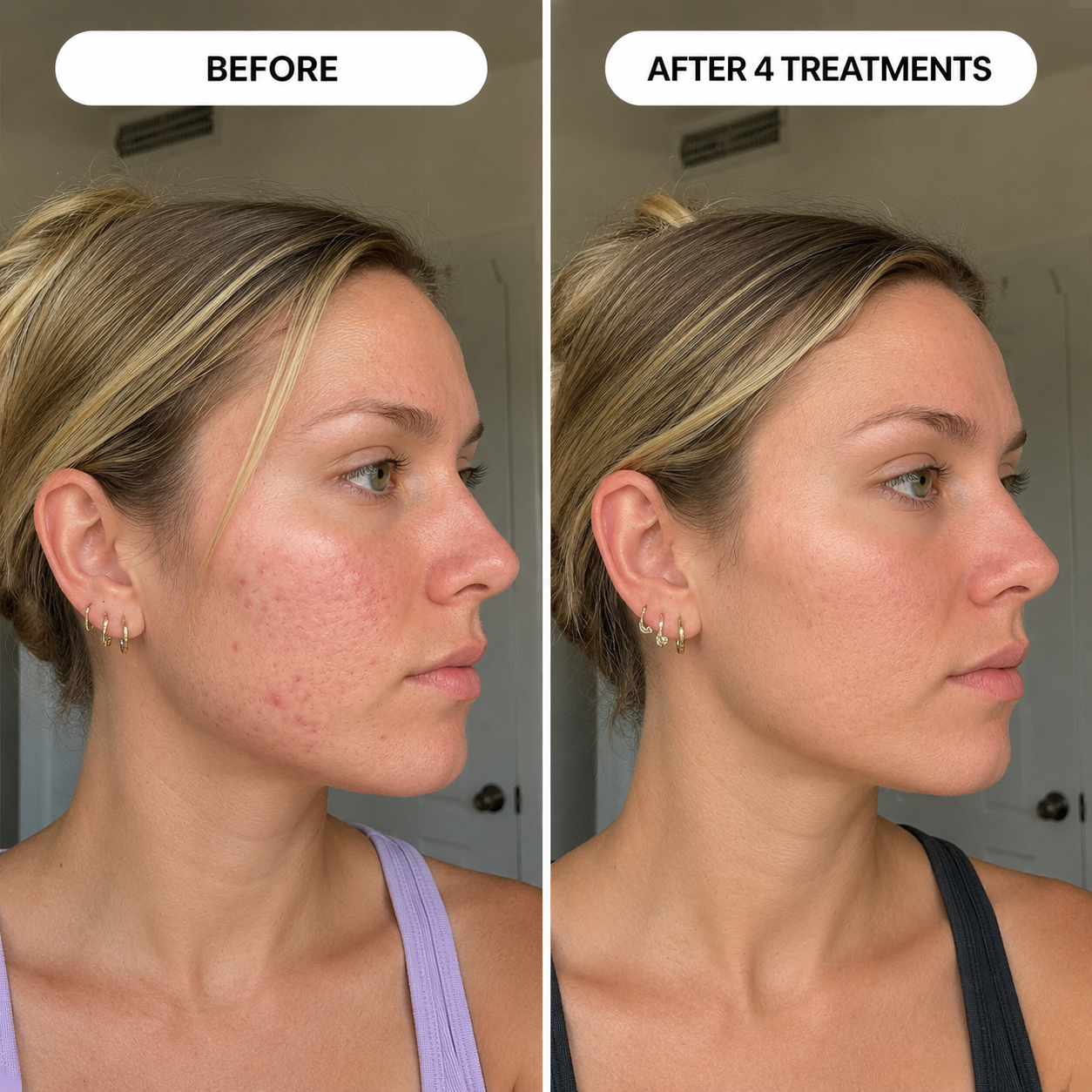 PDRN Micro-Infusion Skin Booster
